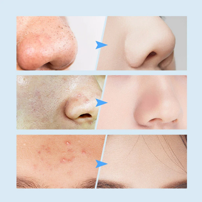 BRELZA electric blackhead suction instrument showing precision nozzle and control buttons for facial pore cleaning.